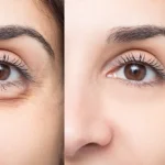 De ce te trezești cu ochii umflați dimineața: explicația unui dermatolog și soluțiile recomandate