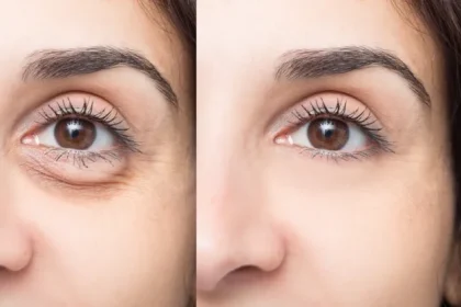 De ce te trezești cu ochii umflați dimineața: explicația unui dermatolog și soluțiile recomandate