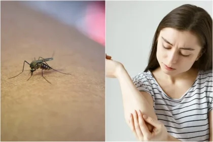 De ce nu e bine să ne scărpinăm după ce ne-a ciupit o insectă. Medicii vin cu explicații și trucuri pentru calmarea zonei