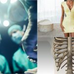 Femeile care își rup coastele ca să își reducă talia. O nouă metodă de remodelare a corpului stârnește îngrijorare în rândul experților